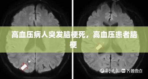 高血压病人突发脑梗死，高血压患者脑梗 