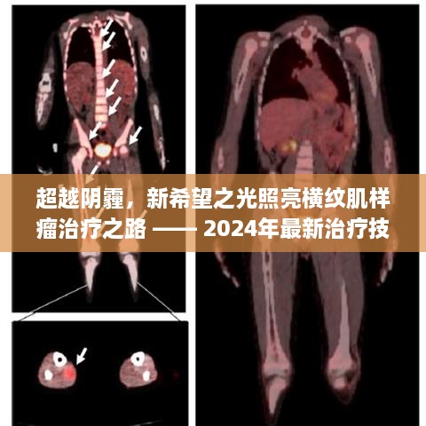 超越阴霾，新希望之光引领横纹肌样瘤治疗之路 —— 2024年最新技术展望